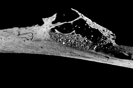 Rakovinu mávali aj neandertálci